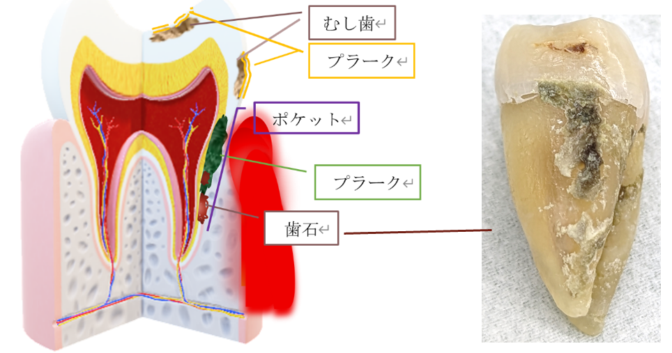 歯石